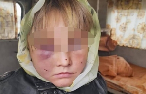 На Житомирщині вітчим жорстоко побив дівчинку, поки її мати була в лікарні