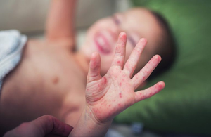 Вакцинація проти кору: на Житомирщині 94,4% дітей у віці 1 року отримали щеплення