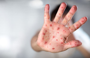 Спалах кору в Житомирі: стало відомо, скільки дітей і дорослих захворіли в цьому місяці
