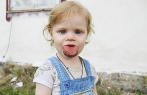 У маленької жительки Житомирщини виявили страшну хворобу: її язик не поміщається в роті