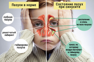 Синусит у детей: правильные методы лечения